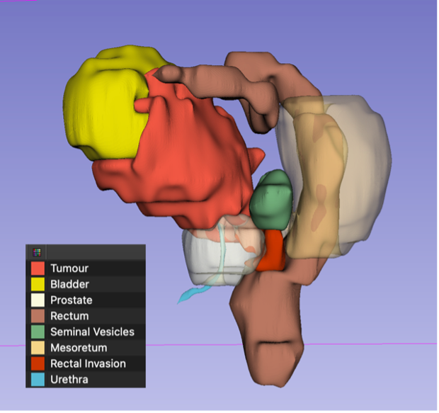 3D anatomical model highlighting tumour and organs.