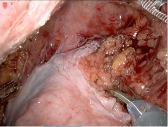 Laparoscopic surgery close-up with surgical instruments.